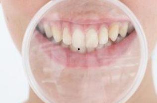 成人磨牙器使用视频教学,轻松告别夜间磨牙烦恼  第1张