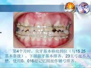 成人磨牙器使用视频教学,轻松告别夜间磨牙烦恼  第3张