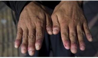 成人啃手指的危害视频  第3张